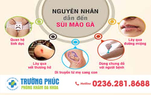 Sùi Mào Gà Ở Hậu Môn Và Những Điều Không Phải Ai Cũng Biết