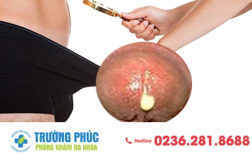 Dương vật chảy mủ - có phải mắc bệnh lậu?