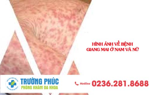 Hình ảnh bệnh giang mai ở nam và nữ