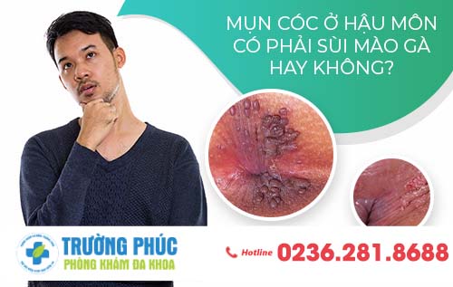 Những đặc điểm nào giúp bạn nhận biết mụn cóc ở hậu môn là sùi mào gà?