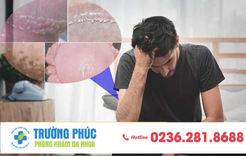 Biểu hiện điển hình nhất ở bệnh nhân mắc bệnh gùi mào gà là gì?