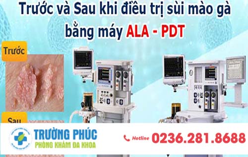 Đã Có Cách Trị Sùi Mào Gà Tốt Hơn Dùng Thuốc, Bạn Đã Biết