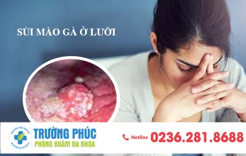 Hậu quả khôn lường khi mắc sùi mào gà ở lưỡi