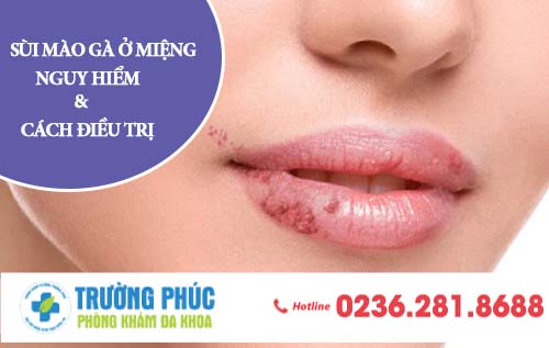 Sùi mào gà ở miệng nguy hiểm như thế nào? Cách điều trị hiệu quả là gì?
