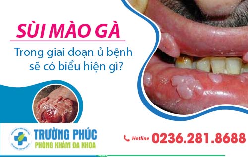 Sùi mào gà ở miệng và cách hỗ trợ điều trị hiệu quả