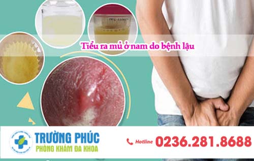 Tiểu ra mủ có phải bệnh lậu không ?