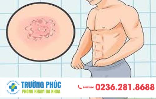 Tìm hiểu về bệnh Herpes sinh dục nam