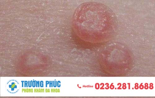 U Hạt Bẹn Và Cách Điều Trị Hiệu Qủa