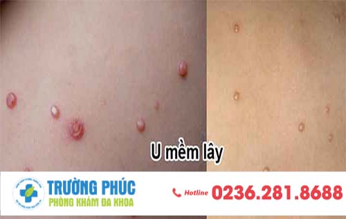 Bệnh U Mềm Lây – Triệu Chứng Và Cách Điều Trị