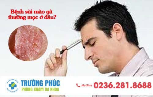 Bệnh sùi mào gà thường mọc ở đâu?