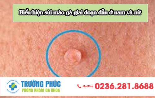 Biểu hiện sùi mào gà giai đoạn đầu ở nam và nữ
