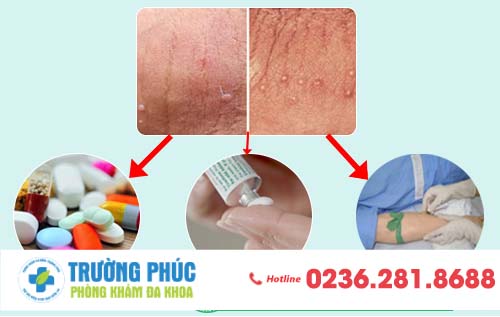 Cách trị sùi mào gà hiệu quả, an toàn, chi phí bình dân nhất hiện nay