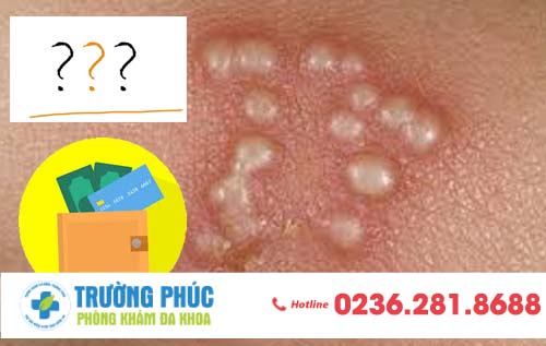 Chi phí hỗ trợ điều trị mụn rộp sinh dục là bao nhiêu?