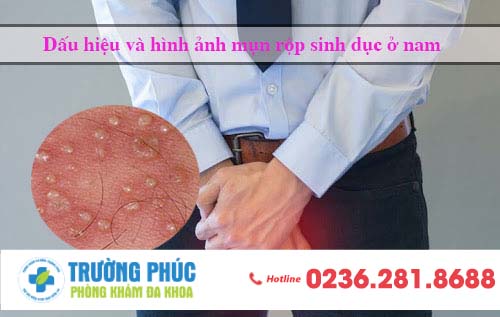 Dấu hiệu và hình ảnh mụn rộp sinh dục ở nam