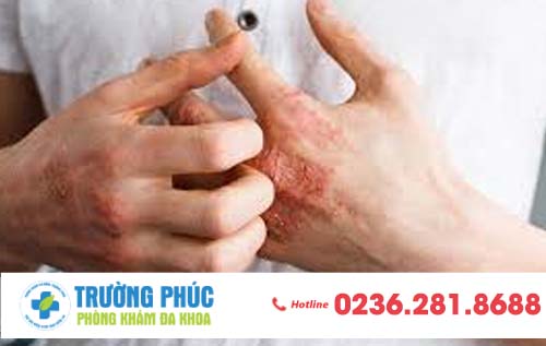 Dấu hiệu nhận biết bệnh giang mai sớm nhất trong 3 tuần đầu tiên