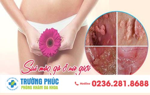 Dấu hiệu cần biết về sùi mào gà nữ