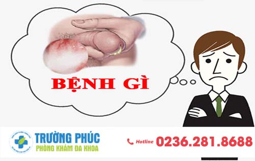 Dương Vật Chảy Mủ - Cẩn Thận Mắc Trọng Bệnh, Không Được Chủ Quan