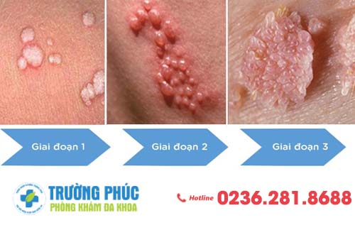 Các giai đoạn sùi mào gà phát triển mà bạn không ngờ tới