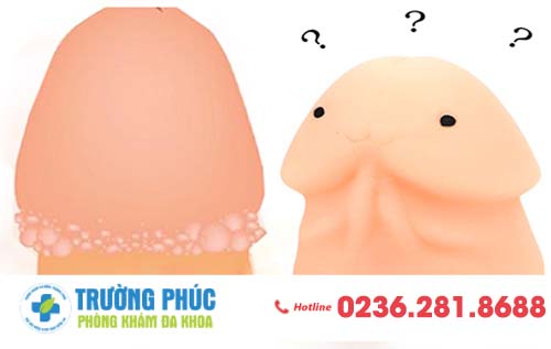 Hạt Ngọc Dương Vật Và Cách Điều Trị Tốt Hơn Thuốc