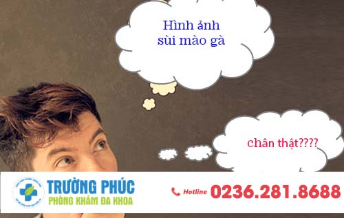Hình ảnh giúp nhận biết sùi mào gà ở người bệnh
