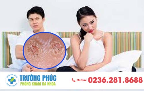 Hình ảnh bệnh sùi mào gà ở nam và nữ giới