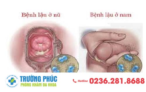 Hình ảnh bệnh lậu ở nam và nữ giới