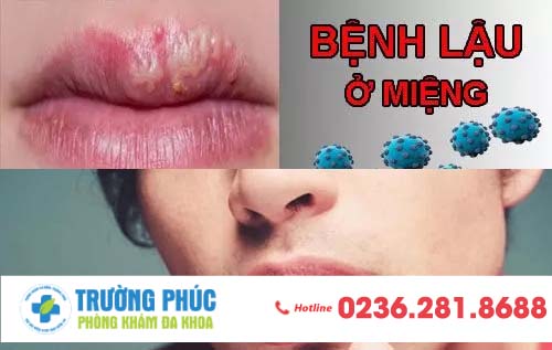 Biểu hiện bệnh lậu ở miệng