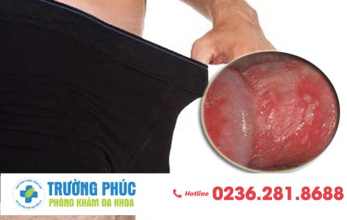 Biểu hiện bệnh xã hội lở loét vùng kín sau quan hệ không an toàn