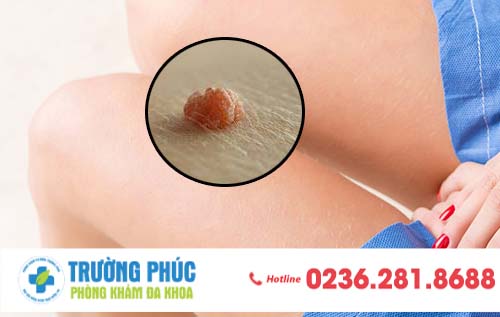 Tìm Hiểu về Mụn Cóc Sinh Dục và phương pháp hỗ trợ điều trị