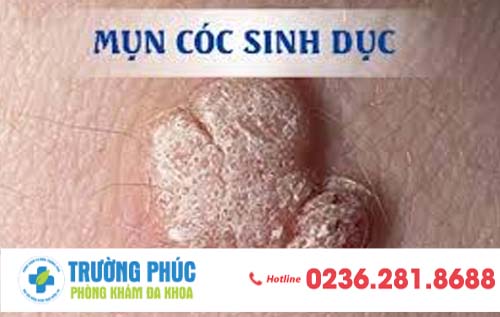 Hình ảnh mụn cóc sinh dục