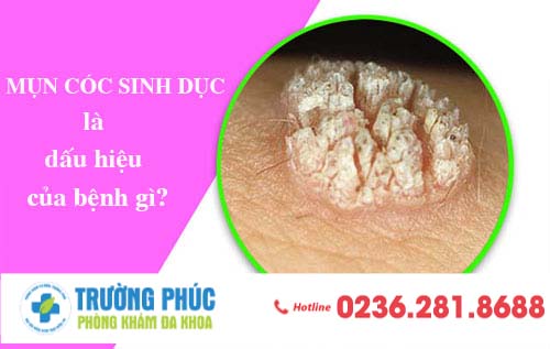 Mụn cóc sinh dục là dấu hiệu của bệnh gì?