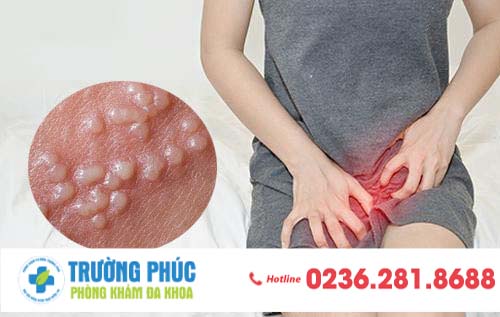 Dấu hiệu nhận biết mụn rộp sinh dục ở nữ