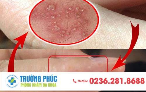 Mụn rộp sinh dục nguyên nhân gây lở loét ở tay chân - cần cảnh giác ngay