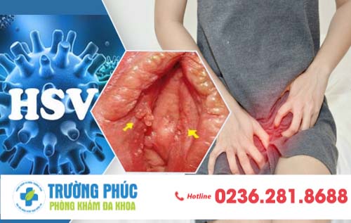 Mụn thịt âm đạo – Biểu hiện của bệnh sùi mào gà