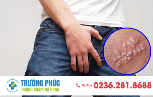 Nổi mụn vùng kín và những điều cơ bản người bệnh cần biết