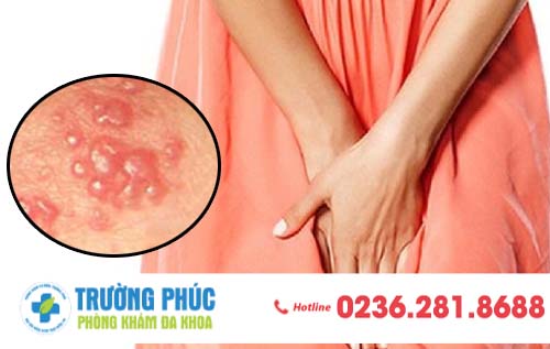 Nổi mụn ở bộ phận sinh dục nam và nữ