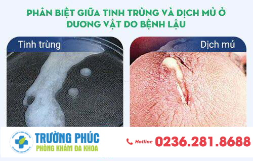 Phân biệt giữa tinh trùng và dịch mủ ở dương vật do bệnh lậu