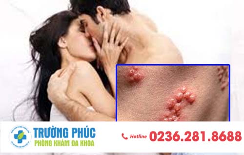 Bệnh lây qua đường tình dục nguy hiểm hiện nay