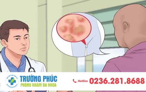 Dương vật nổi mụn - nguy cơ bạn đang mắc sùi mào gà