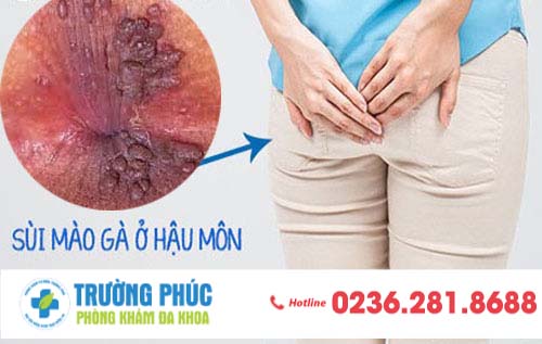 Nổi mụn thịt hậu môn - dấu hiệu cảnh báo mắc sùi mào gà hậu môn nguy hiểm