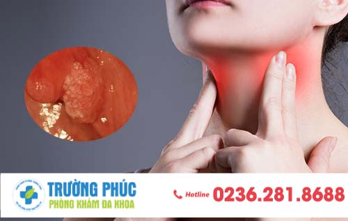 Sùi mào gà ở họng có biểu hiện như thế nào?