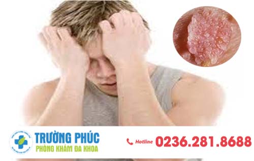 Sùi mào gà, bệnh dễ lây nhưng có khó chữa hay không ?