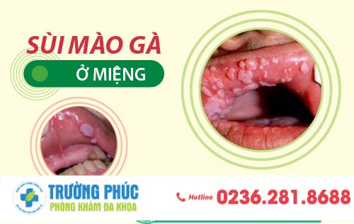Sùi mào gà ở miệng