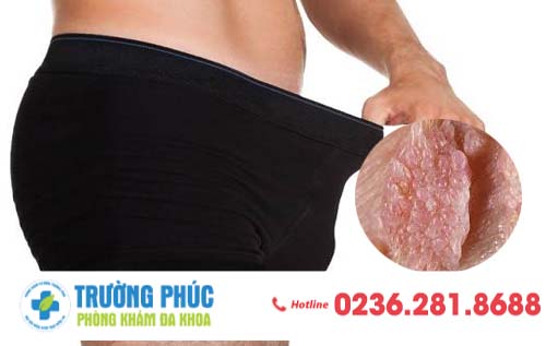 Tìm hiểu bệnh sùi mào gà ở dương vật