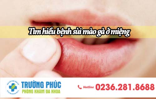 Tìm hiểu bệnh sùi mào gà ở miệng
