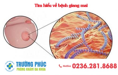 Tìm hiểu về bệnh giang mai