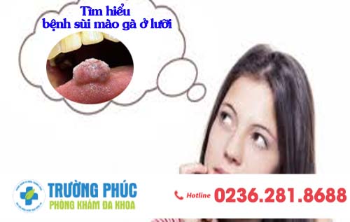 Tìm hiểu bệnh sùi mào gà ở lưỡi