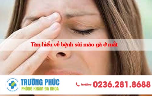 Tìm hiểu về bệnh sùi mào gà ở mắt