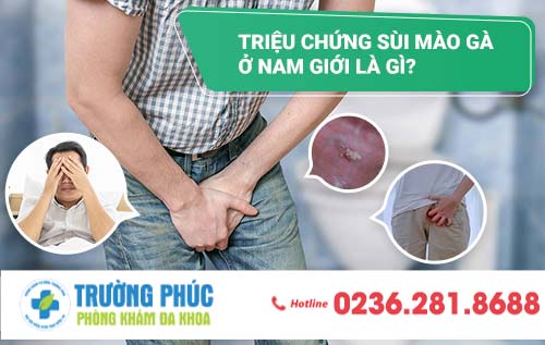 Triệu chứng sùi mào gà ở nam giới là gì?